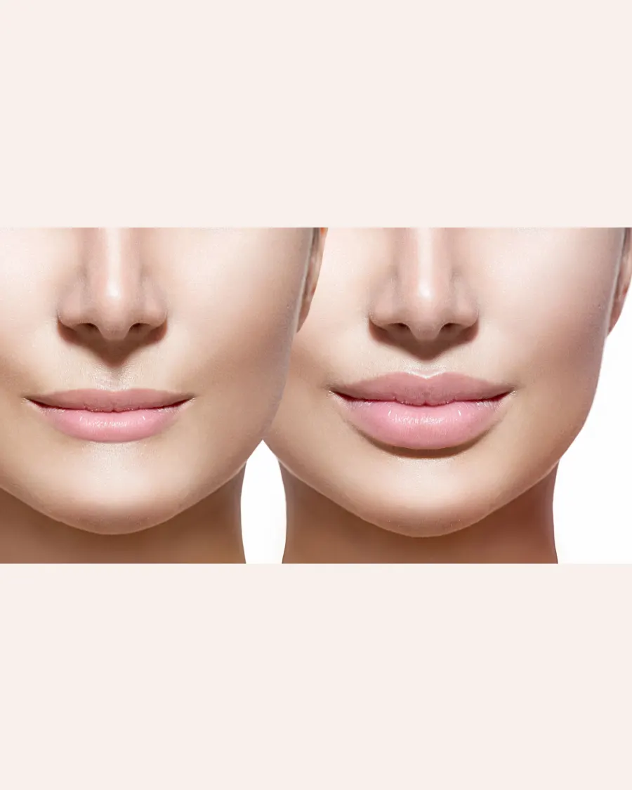 Lip Augmentation at Cinch Clinics